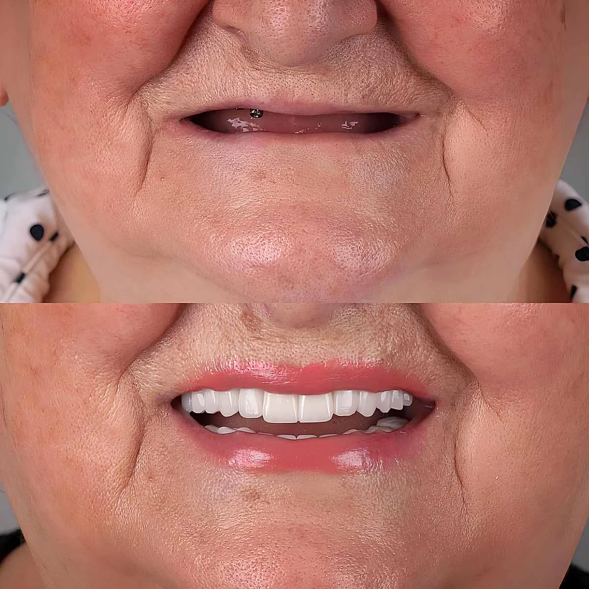 Immediate dentures